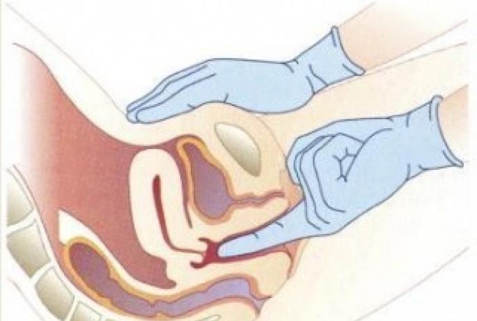 Prolapsul pereților vaginali, cauze, tratament, exerciții, intervenții chirurgicale pentru prolaps și prolaps Ce să faci când peretele posterior al uterului coboară