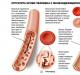 Hemoglobină scăzută - cauze și consecințe la femei